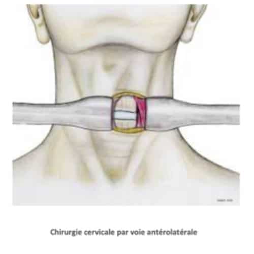 chirurgie cervicale par voie anterolaterale myelopathie cervicarthrosique irm myelopathie symptomes myelopathie cervicale et fatigue centre du rachis