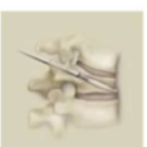 fracture osteoporotique traitement 1 osteoporose fracture vertebrale centre du rachis