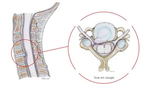 Hernie discale cervicale et névralgie cervico-brachiale - Centre ...