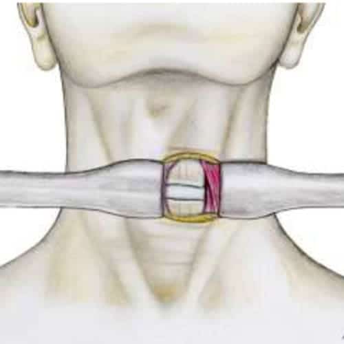 nevralgie cervico-brachiale duree nevralgie cervico brachiale traitement recommandations nevralgie cervico brachiale cancer nevralgie cervico brachiale arret de travail centre du rachis